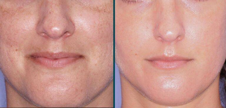 Improved skin from 1 MOXI laser treatment