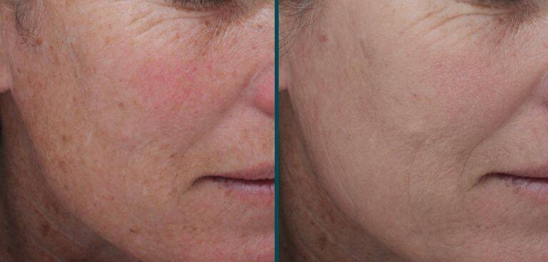 Improved skin from MOXI laser treatment