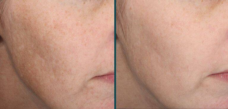 Improved skin as a result of MOXI laser treatment