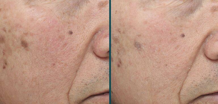 Results from ClearSilk laser skin treatment