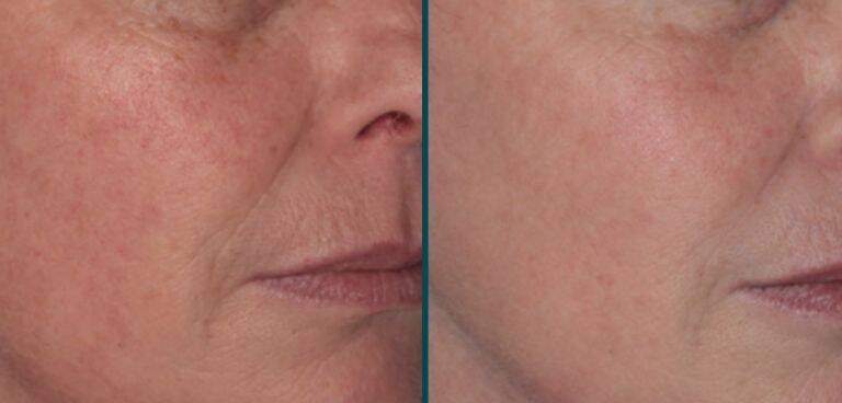 Results from ClearSilk Laser Treatment