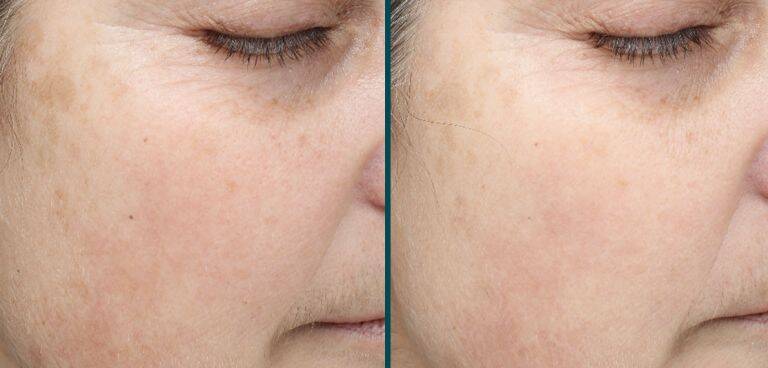 Skin Improvements from ClearSilk Laser Treatment