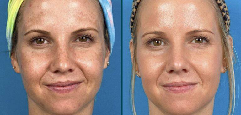 Skin Improvements from HALO Laser Skincare Treatment