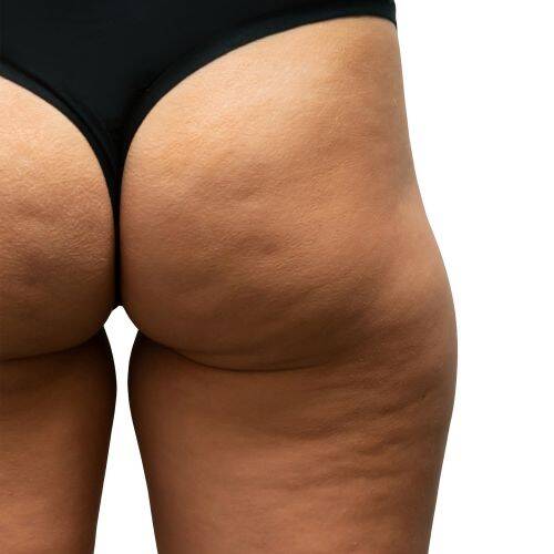 cellulite is a treatable concern at NuIQ