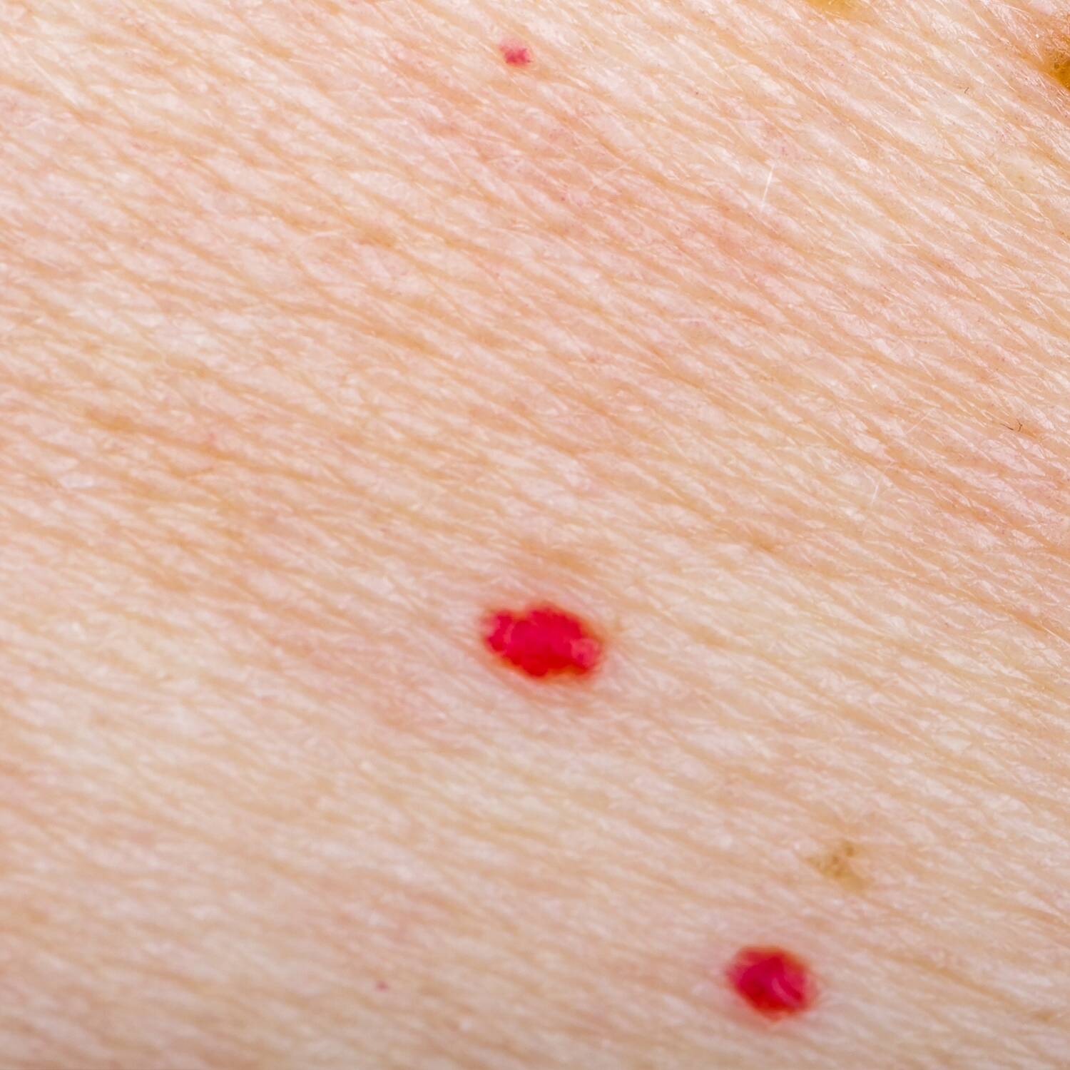 cherry angiomas is a treatable condition at NuIQ