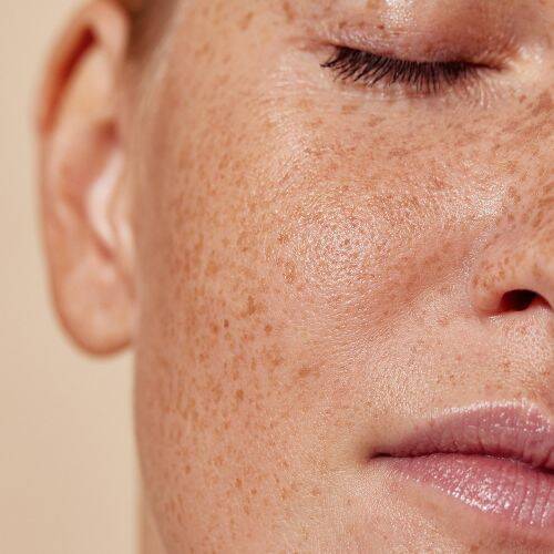 freckles are a treatable concern at NuIQ