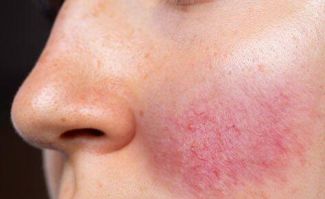 Rosacea