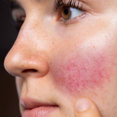 rosacea is a treatable concern at NuIQ