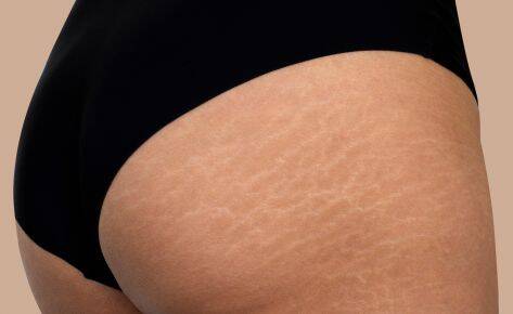 Stretch Marks