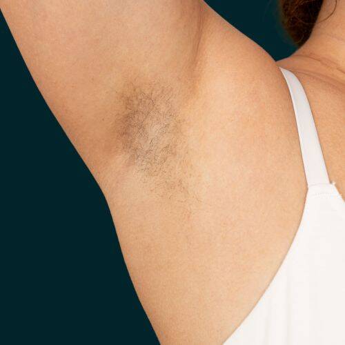 unwanted underarm hair