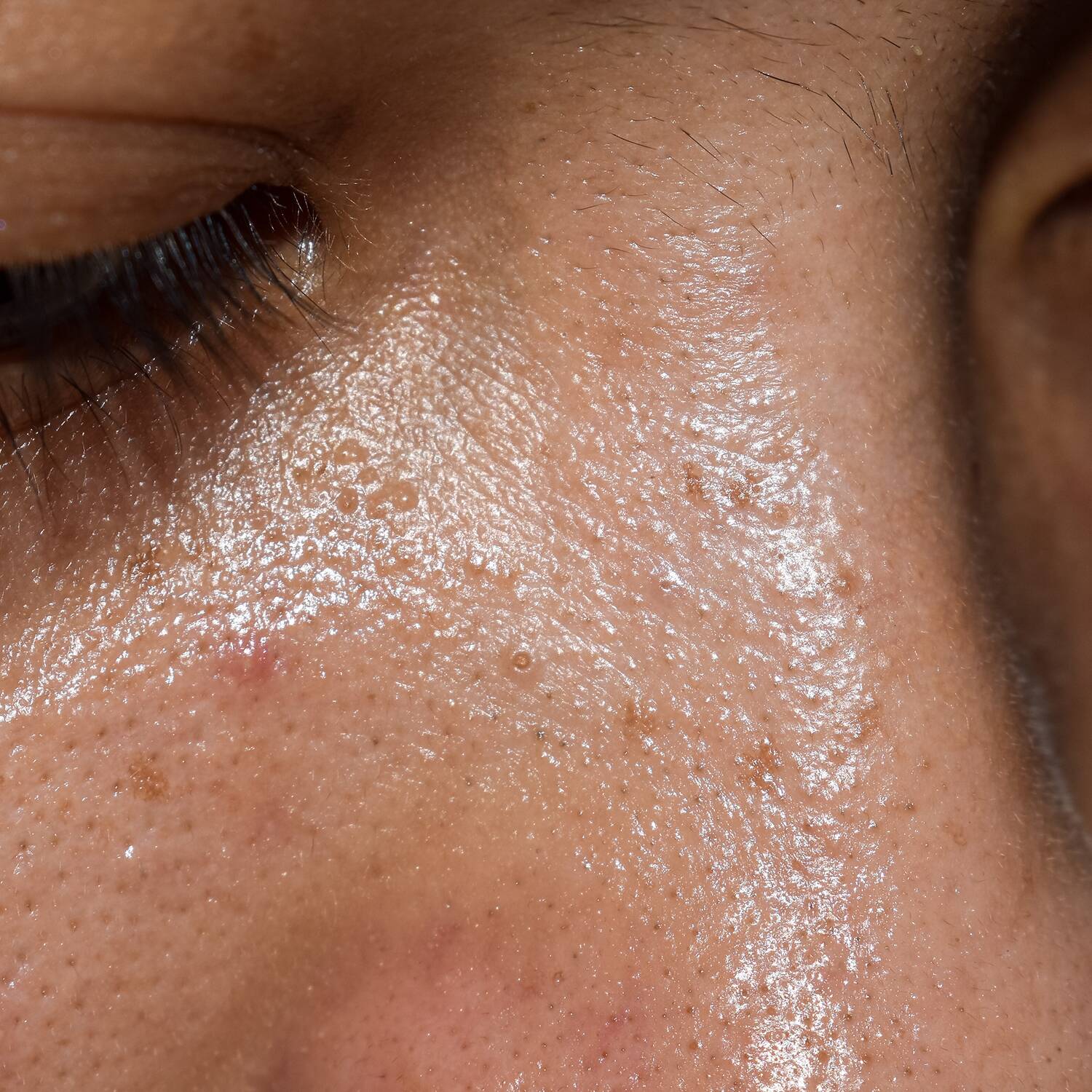 oily skin a treatable concern