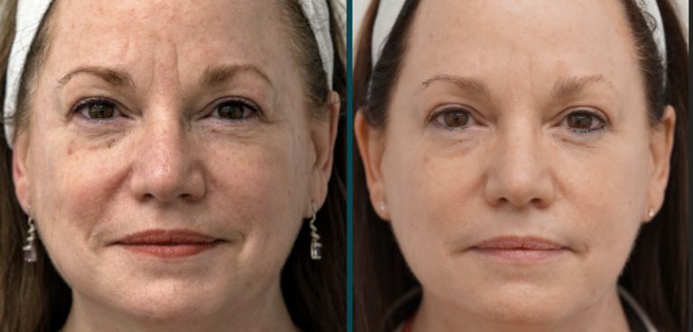 Skin Improvements from BBL Laser Treatment