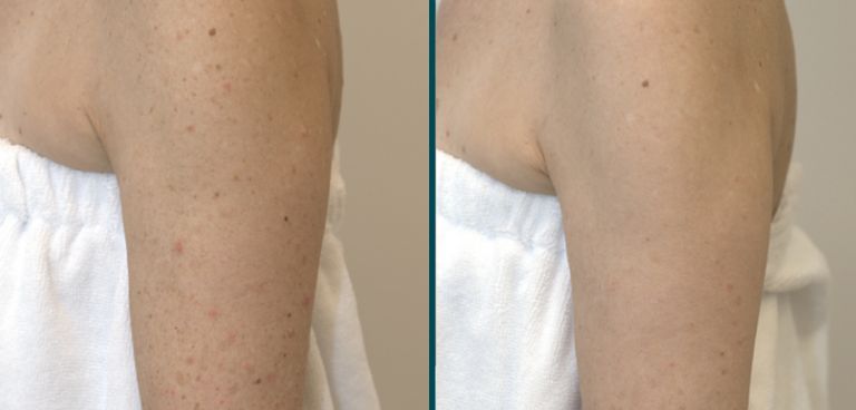 Skin improvements to arms from BBL Hero Laser Treatment