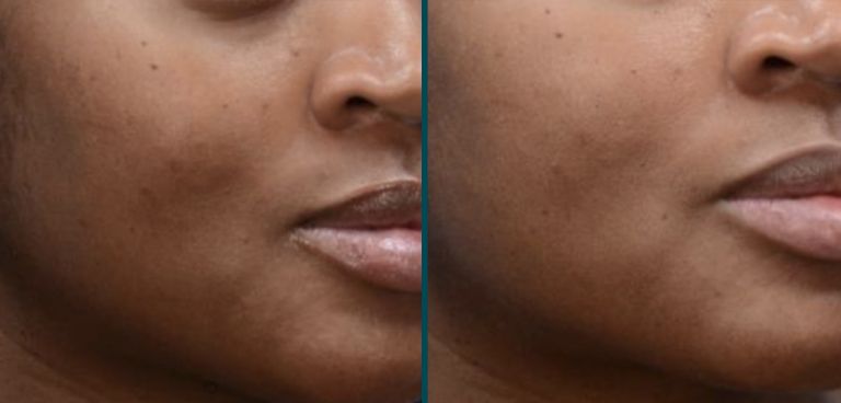 Improved appearance of skin after MOXI laser treatment