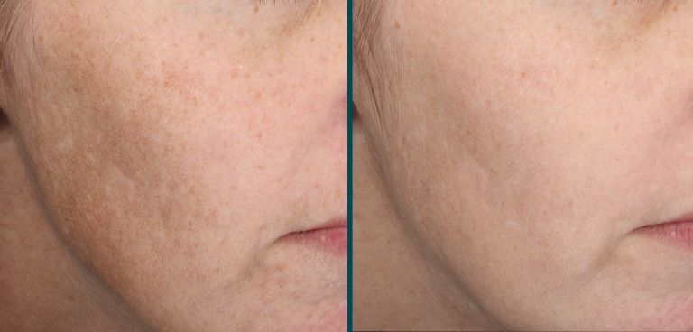 Improved skin as a result of MOXI laser treatment