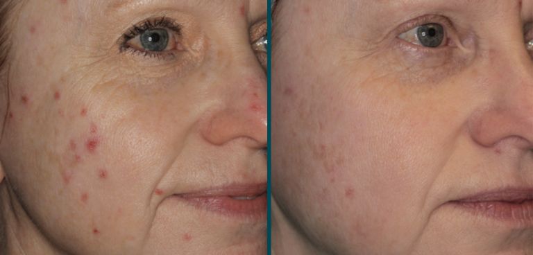 Woman's incredible results from acne to clear skin with Forever Clear BBL Treatment