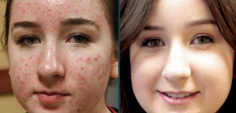 amazing results from teen's acne treatment from Forever Clear BBL