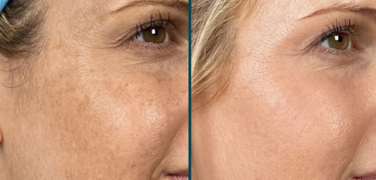 Skin improvements from HALO laser treatment