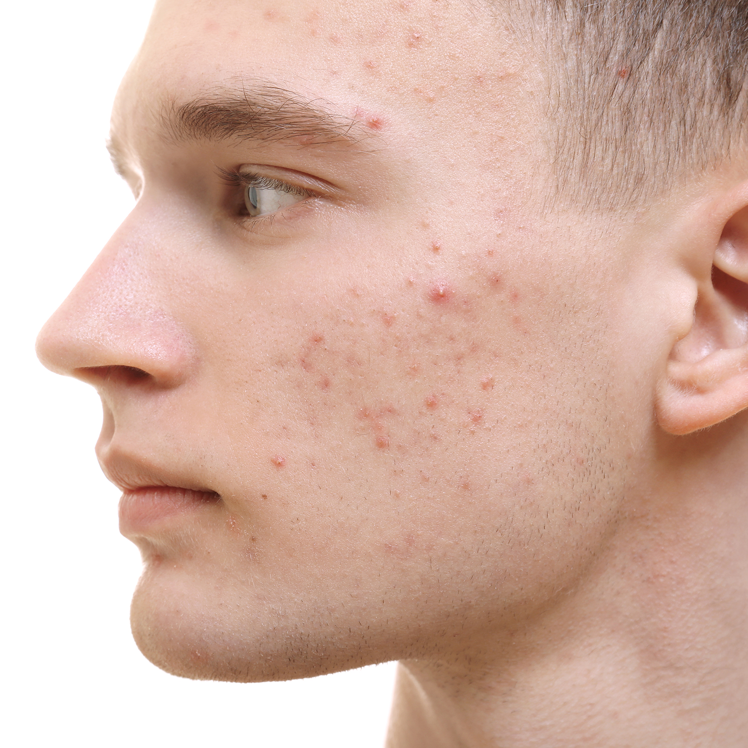 acne is a treatable condition at NuIQ Wellness Lounge