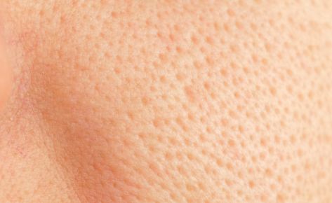 Enlarged Pores