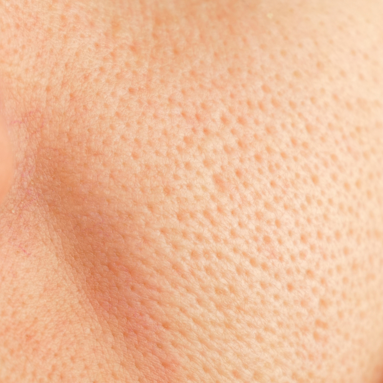 enlarged pores are a treatable concern at NuIQ