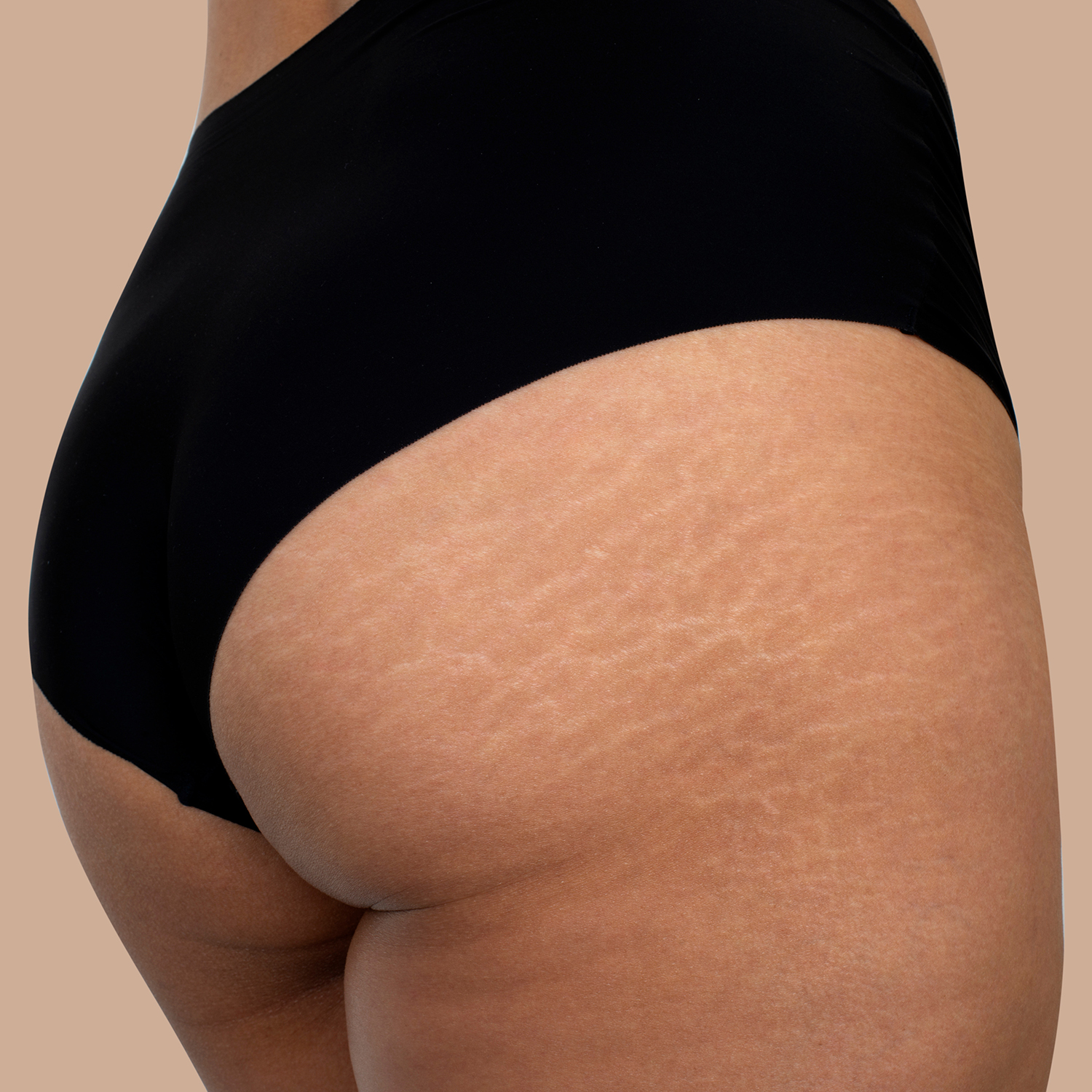 stretch marks are a treatable concern at NuIQ Wellness Lounge