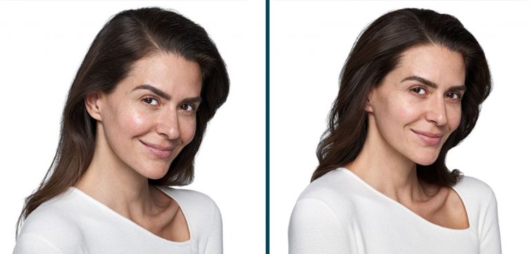 woman's skin improvement shown by before and after SKINVIVE