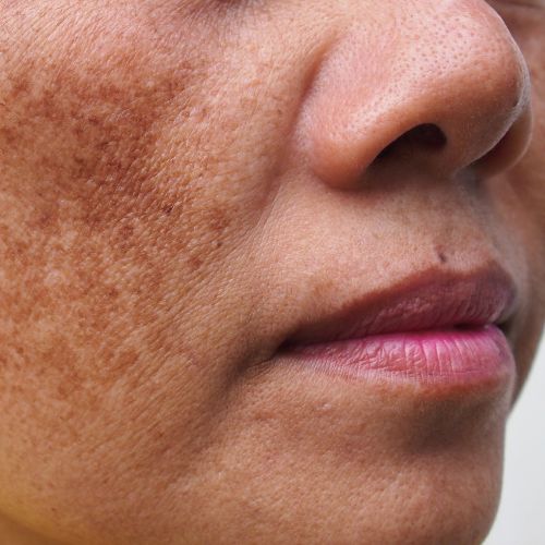 melasma is a treatable concern at NuIQ