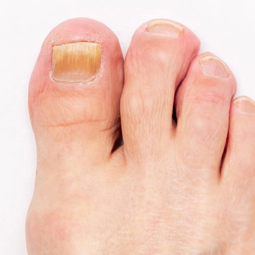 nail fungus - treatable concern