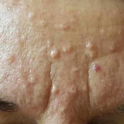 sebaceous hyperplasia