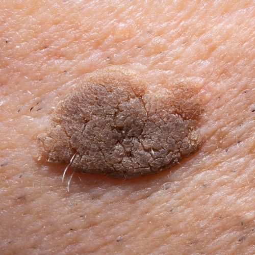 seborrheic keratosis skin condition