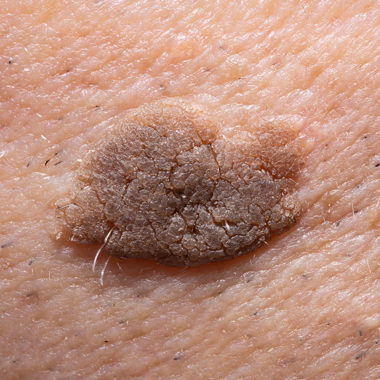 seborrheic keratosis skin condition