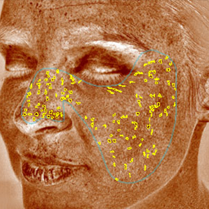 visia skin analysis showing brown spots