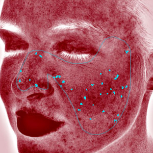 visia skin analysis showing red areas