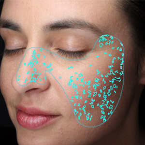 visia skin analysis showing skin spots