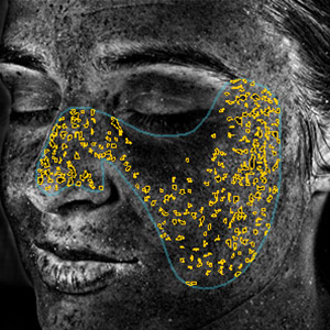 visia skin analysis showing UV spots